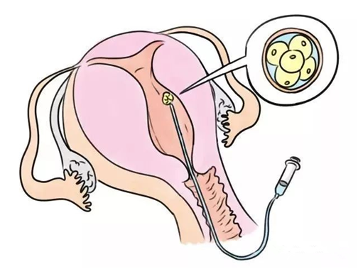 AMH0.68卵巢早衰3年,试管两次失败,泰国求子儿女双全